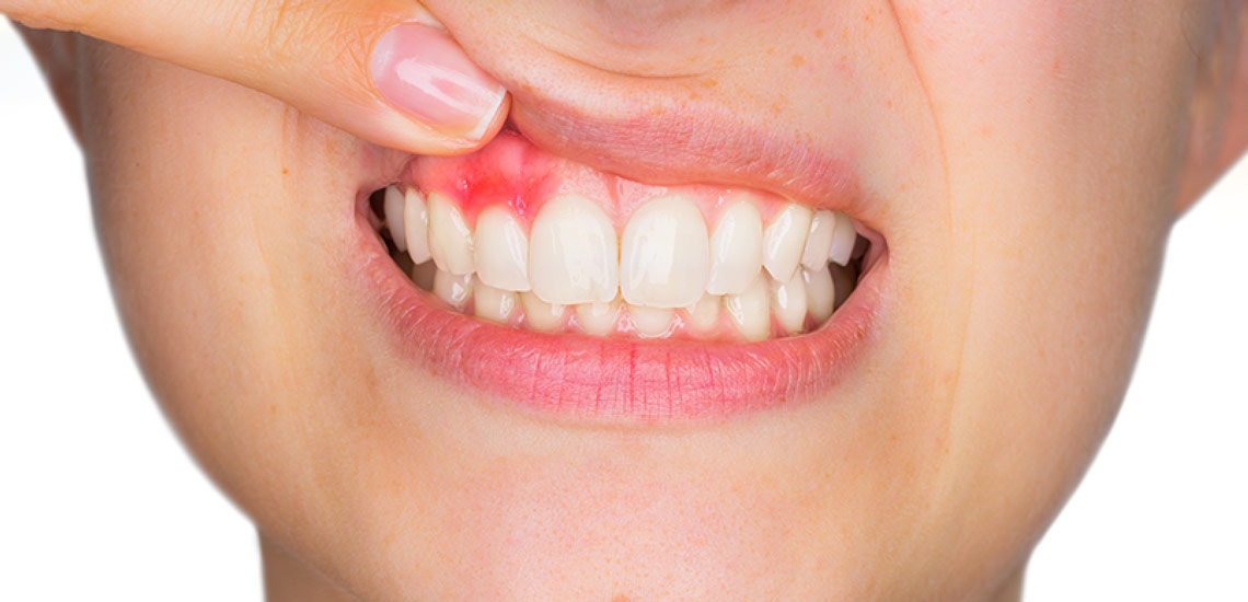 درمان آبسه دندان با نشاسته