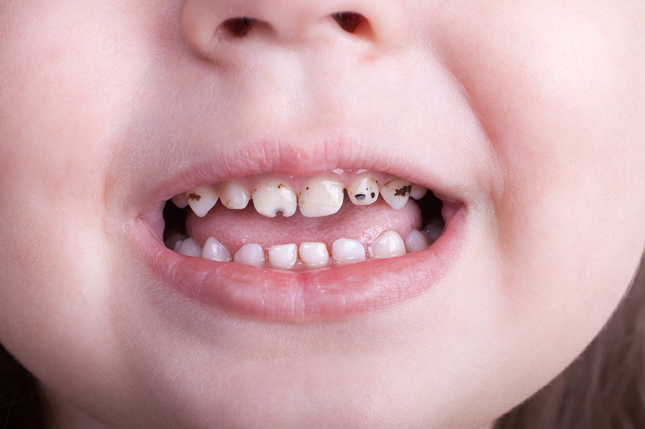 پوسیدگی دندان بطری کودک چیست؟