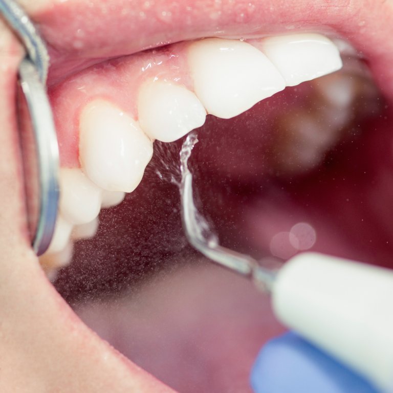 جرم گیری تارتار دندان چیست؟ چگونه انجام می شود؟