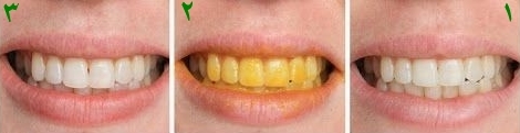 سفید شدن دندان با زردچوبه