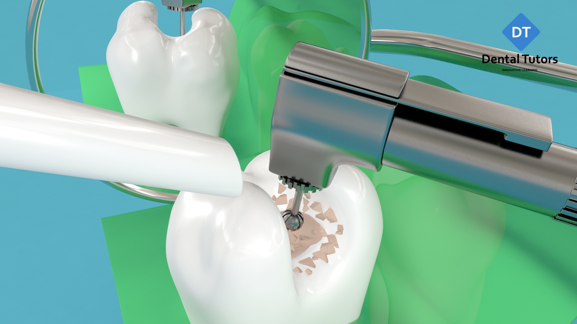 درمان کانال ریشه دندان و مواردی که پس از درمان باید به آن توجه کنید