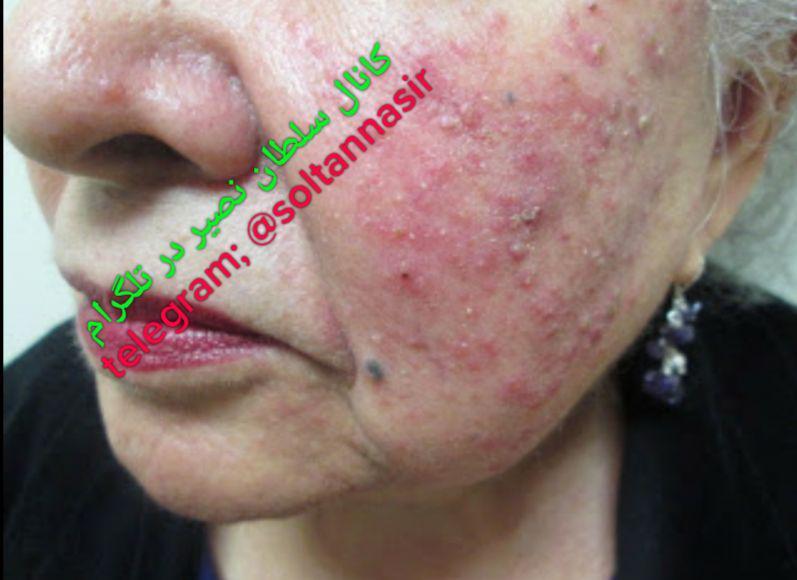 تصویر صورت فردی که بر اثر مسمومیت جیوه دچار مشکلات حاد پوستی شده است