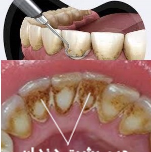 18 روش درمان جرم دندان