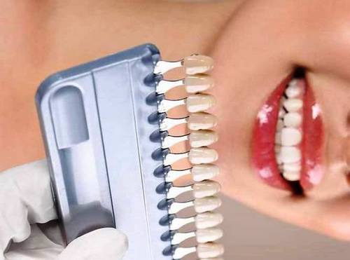 انواع مختلف روکش دندان را بهتر بشناسید