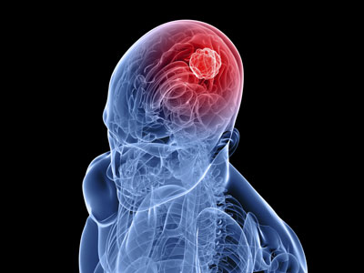 آنچه باید دربارۀ تومورهای مغزی بدانید؟