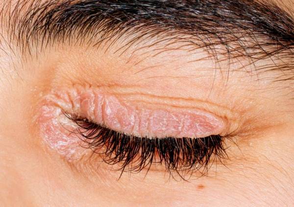 خشکی پوست دور چشم و ۷ درمان خانگی حیرت آور