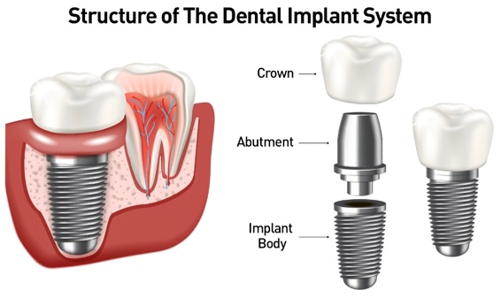 موارد مهمی که باید قبل از جراحی ایمپلنت دندان بدانید