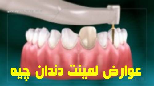 عوارض لمینت دندان چیه 