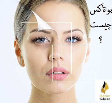 بوتاکس صورت