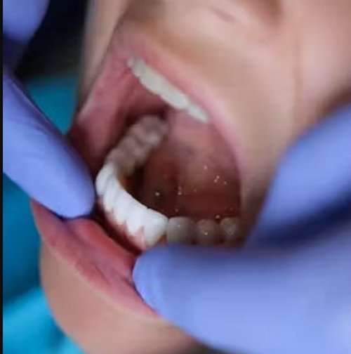 نوع لمینت دندان تجربه لابراتوار + تجربه پزشک 