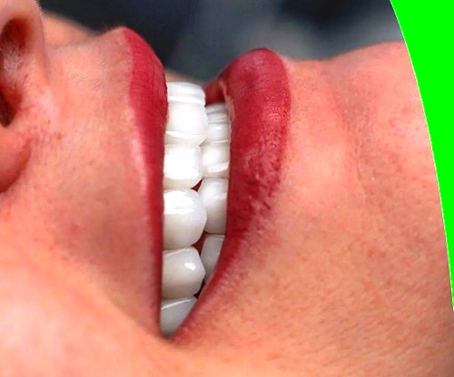 لمینت دندان  ایمکس چیست+ خصوصیات و مزایا
