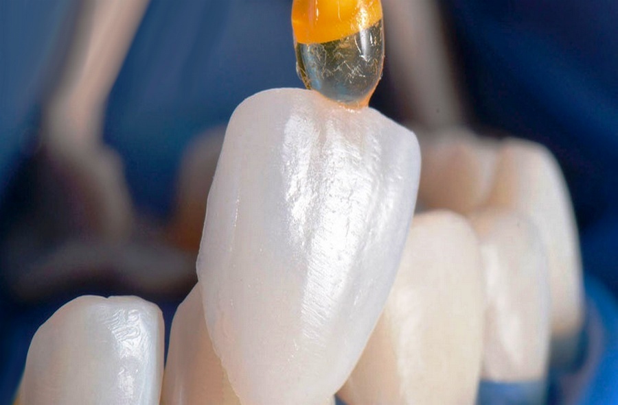 مهارت نصب در قرار دادن لمینت دندان بسیار مهم است 