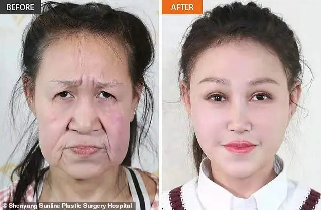 جراحی زیبایی باور نکردنی صورت یک دختر چینی + عکس
