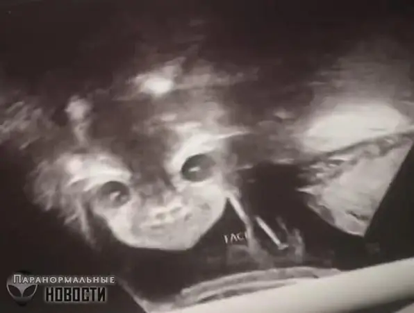 عجیب ترین سونوگرافی که تصویر یک نوزاد ترسناک را نشان داد + عکس