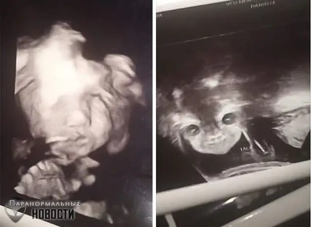 عجیب ترین سونوگرافی که تصویر یک نوزاد ترسناک را نشان داد + عکس
