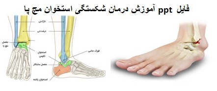 دانلود رایگان ppt آموزش درمان شکستگی استخوان مچ پا 24 اسلاید