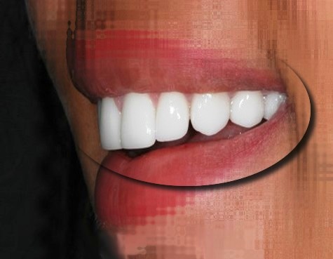 بارزترین مزیت لمینت سرامیکی دندان دقیقا چیست