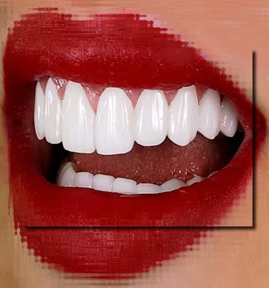 اصلی ترین مزیت لمینت دندان کامپوزیت چیست 