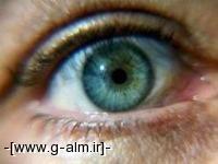  علائم هشداردهنده بیماری آب سیاه چشمی را جدی بگیرید 