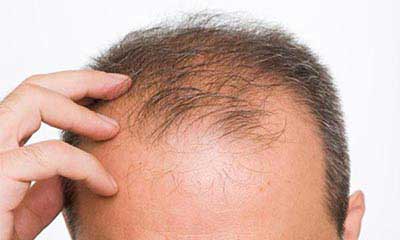 6  عامل مهم ریزش مو در آقایان