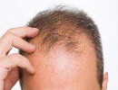 مهمترین عوامل ریزش مو در مردان