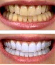 زردی دندان ها را چگونه برطرف کنیم ؟