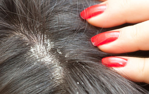 درمان ساده شوره موی سر